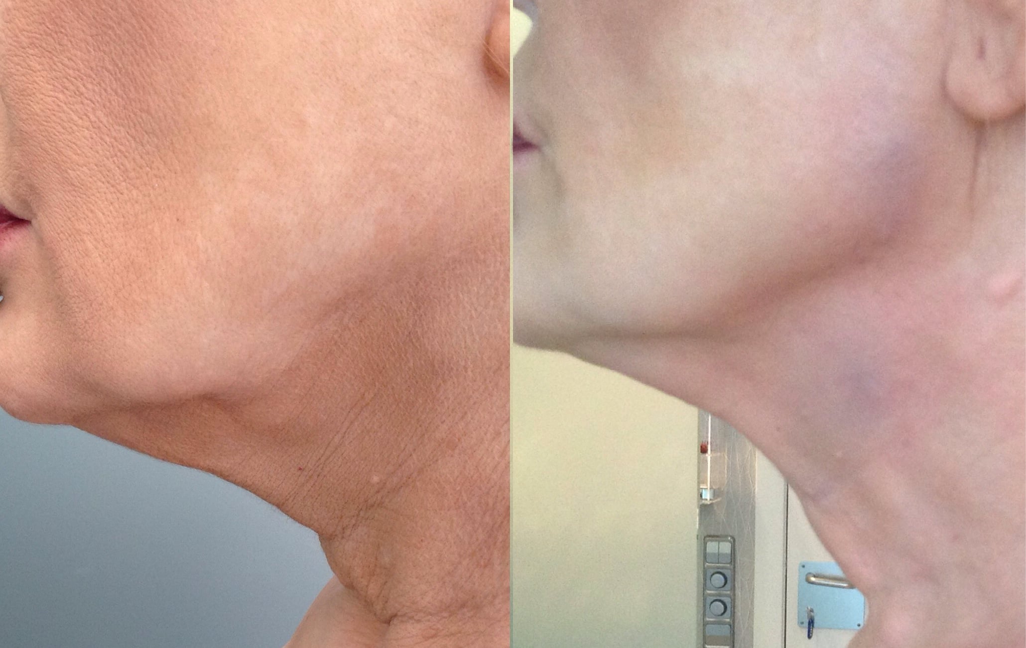 ¡Cómo eliminar las arrugas del cuello y escote! [100% Efectivo]